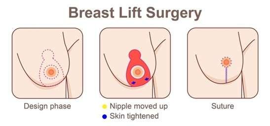 Who is Eligible for Breast Lift