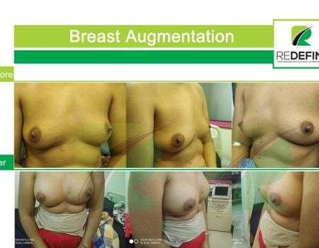 Breast Augmentation 1