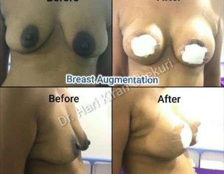 Breast Augmentation 3