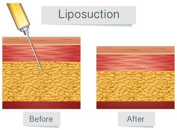 Liposuction-Assisted Breast Reduction