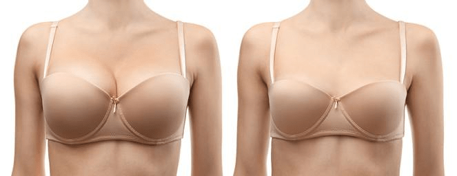 Success Rates of Breast Reduction