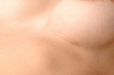 Causes of Breast Lift Scars