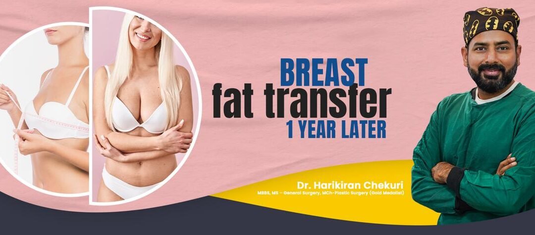 Breast Fat Transfer 1 Year Later