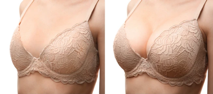 Success Rates of Breast Fillers