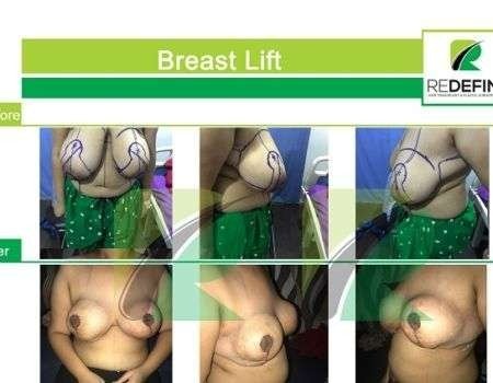 breast lift