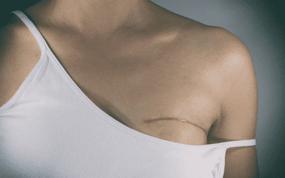 Breast Reconstruction After Mastectomy