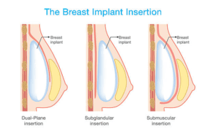 Procedure